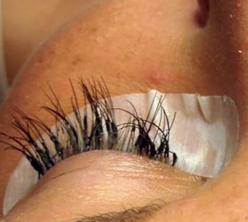 Λάθος εφαρμογή eyelash extensions με υπερβολική κόλλα και πολλές φυσικές βλεφαρίδες κολλημένες μεταξύ τους.