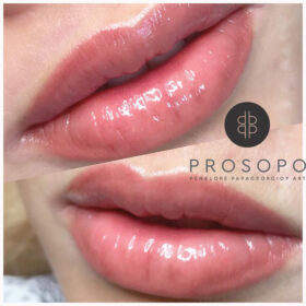 lips tattoo-πριν και μετα