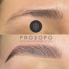 πριν και μετα σχηματισμος φρυδιων χαλανδρι