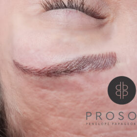 eyebrow-treatment-chalandri.jpg