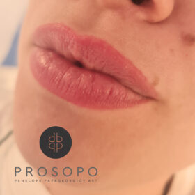 pmu-lips-healed-full-lips-xalandri-prosopo.jpg