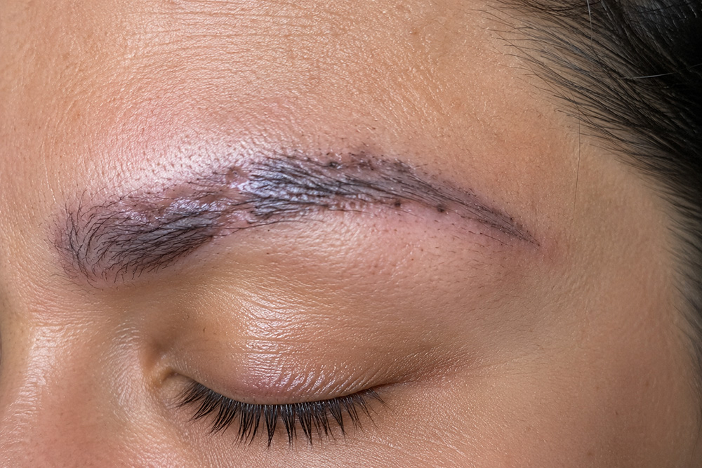 Ουλές στο φρύδι μετά από αποτυχημένο Microblading λόγω λανθασμένης τεχνικής εφαρμογής και τραυματισμού του δέρματος.